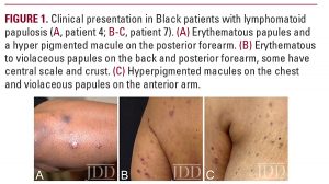 Lymphomatoid Papulosis