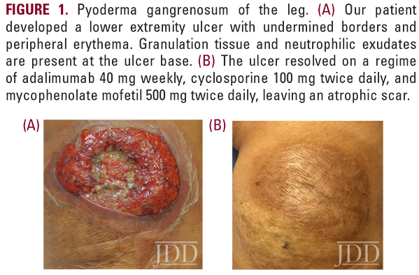 Pyoderma Gangrenosum