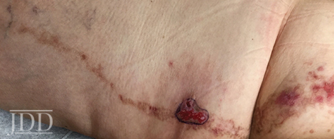 squamous cell carcinoma