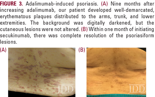 Adalimumab-induced psoriasis