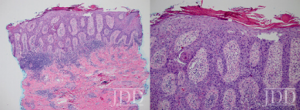 psoriasiform epidermal hyperplasia and atypical keratinocytes