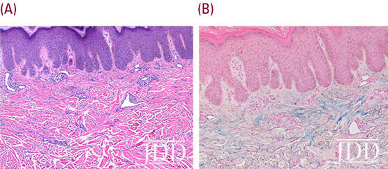 Histopathology of lesional skin