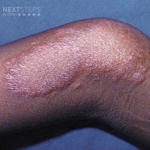 tuberculoid leprosy symptoms