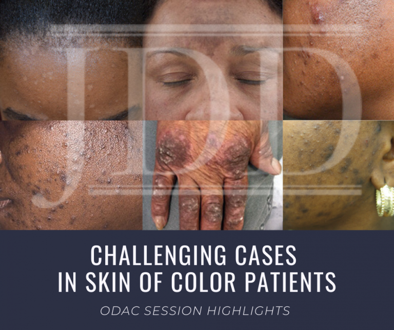 Challenging Cases in Skin of Color Patients - Next Steps in Dermatology