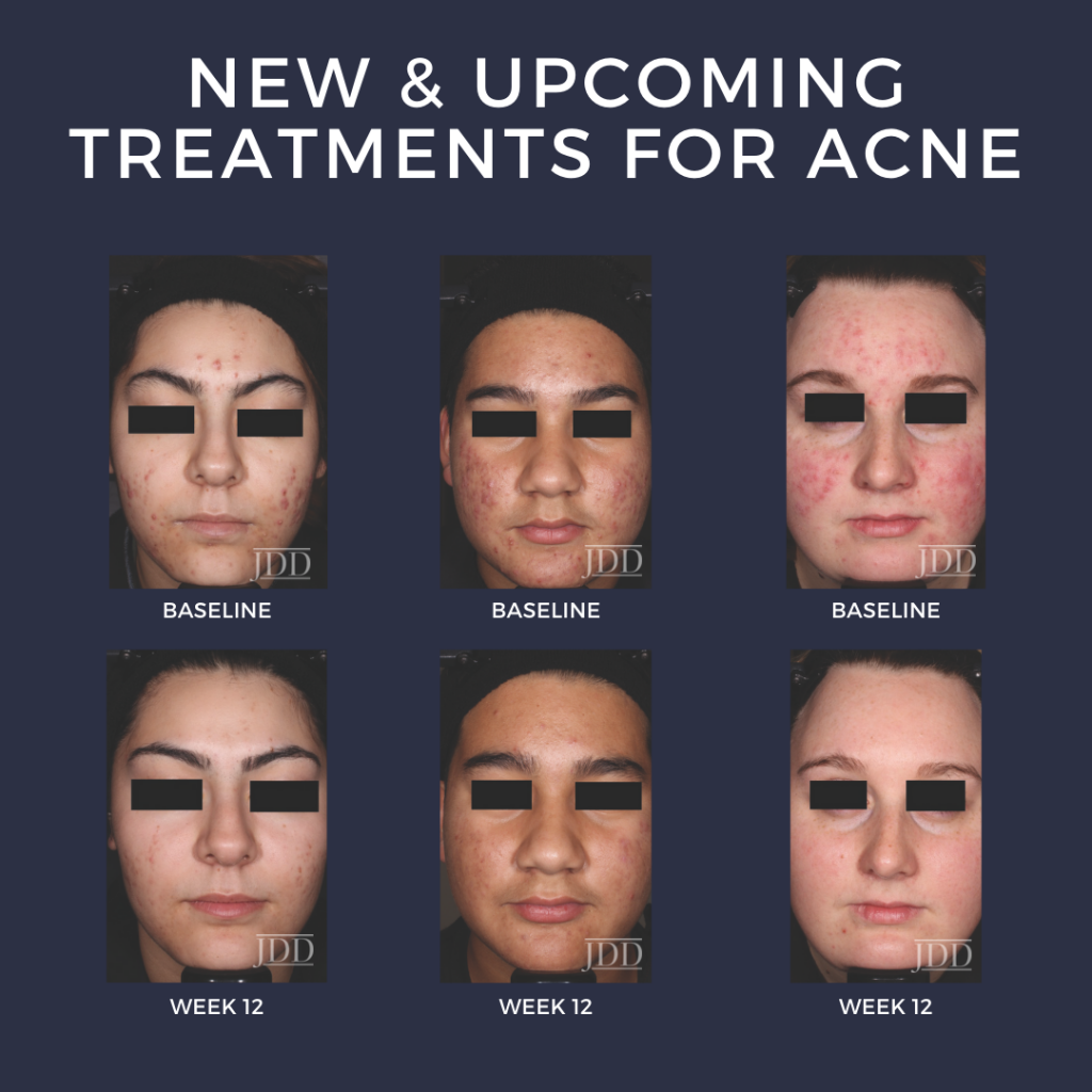 new research on acne
