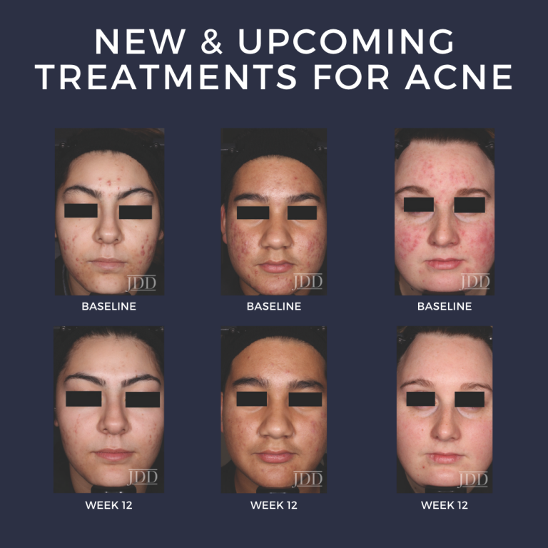 New and Treatments for Acne Next Steps in Dermatology
