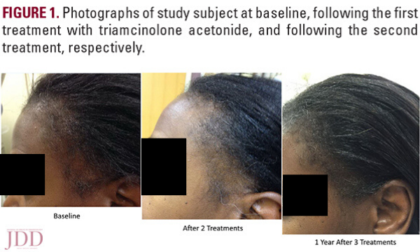 Intralesional Triamcinolone Acetonide In The Treatment Of Traction Alopecia Next Steps In Dermatology