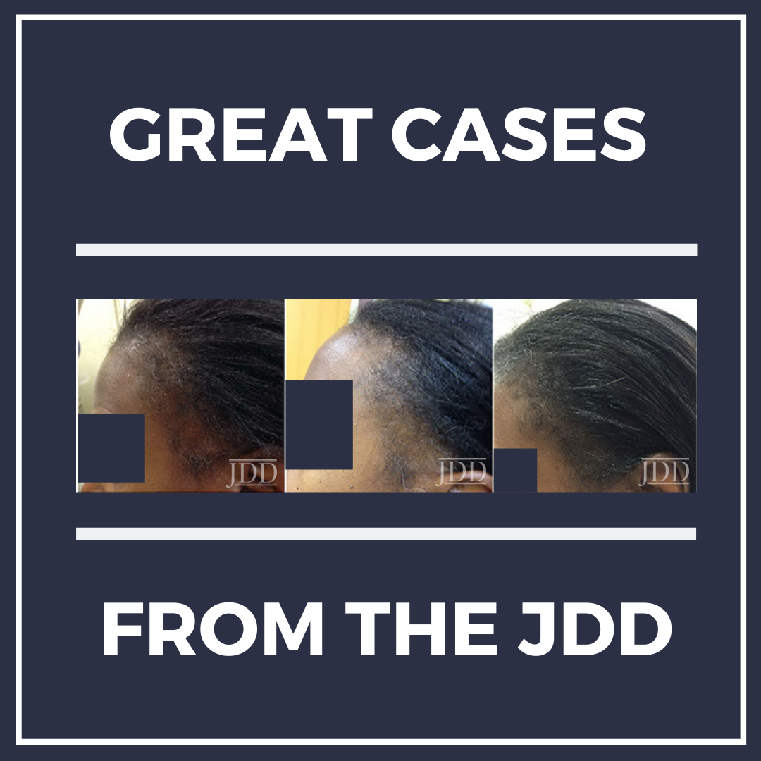 Intramuscular triamcinolone acetonide An undervalued option for refractory  alopecia areata  Seo  2017  The Journal of Dermatology  Wiley Online  Library