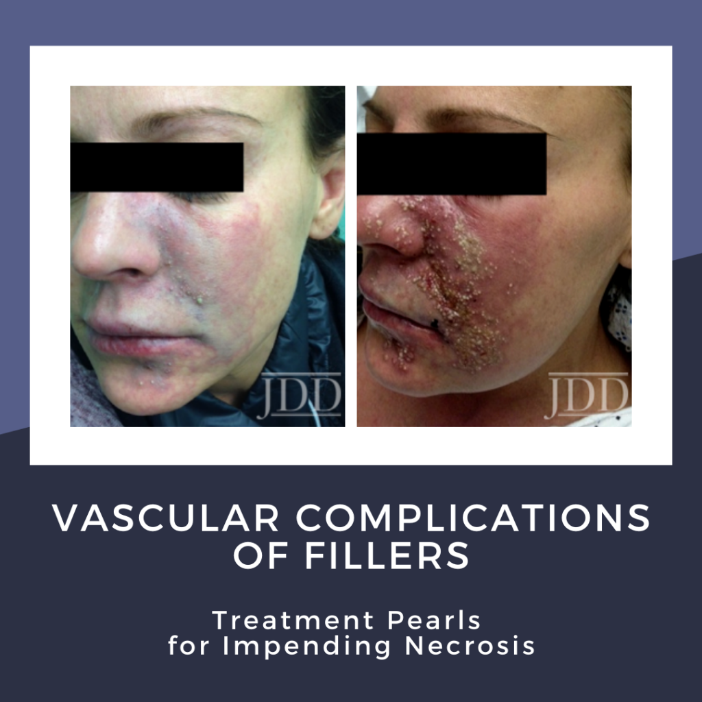 Vascular Complications of Fillers Treatment Pearls for Impending
