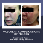 Vascular Complications of Filler