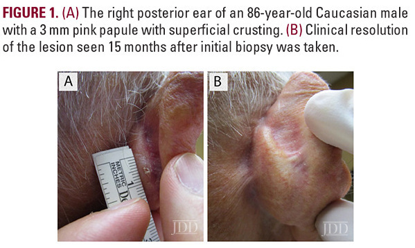 Invasive SCC