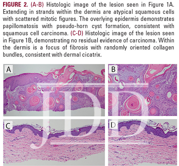 Invasive SCC