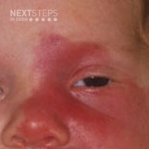 Sturge-Weber syndrome