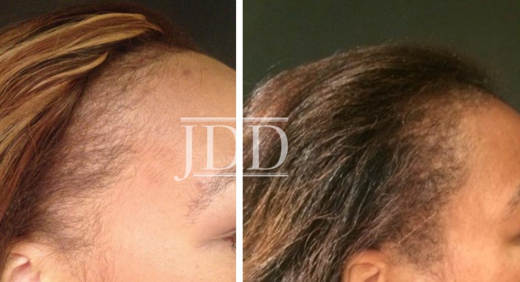 A Closer Look at a Multi-Targeted Approach to Hair Loss in African American  Women - Next Steps in Dermatology