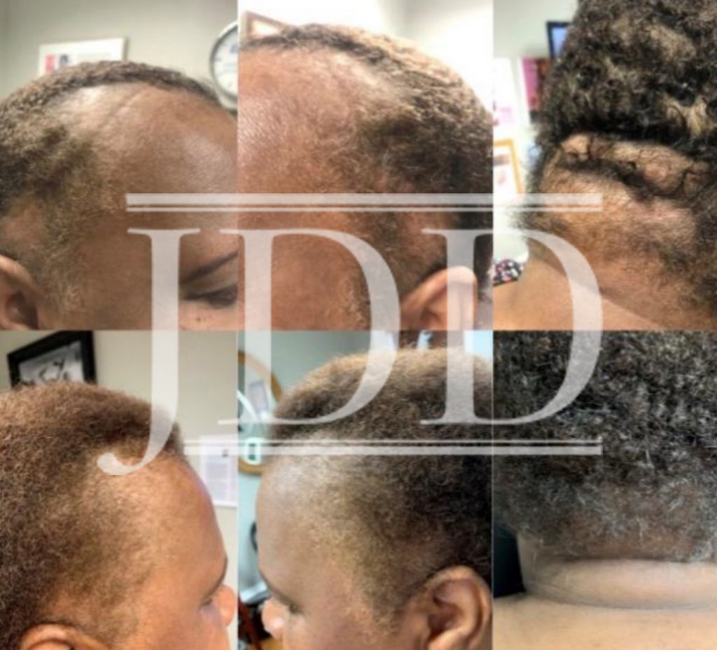 Hair loss in African American Women