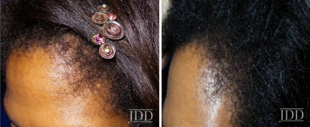 Hair loss in African American Women