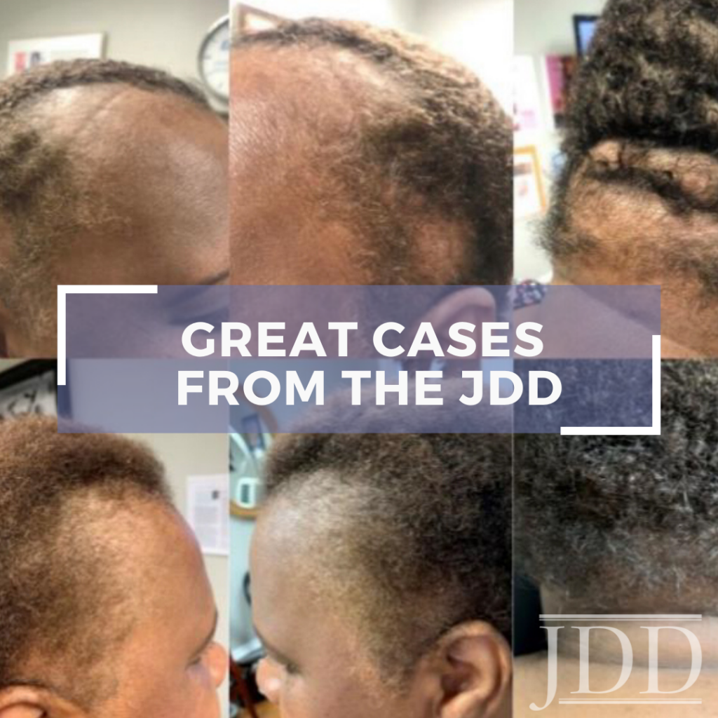 A Closer Look At A Multi Targeted Approach To Hair Loss In African American Women Next Steps