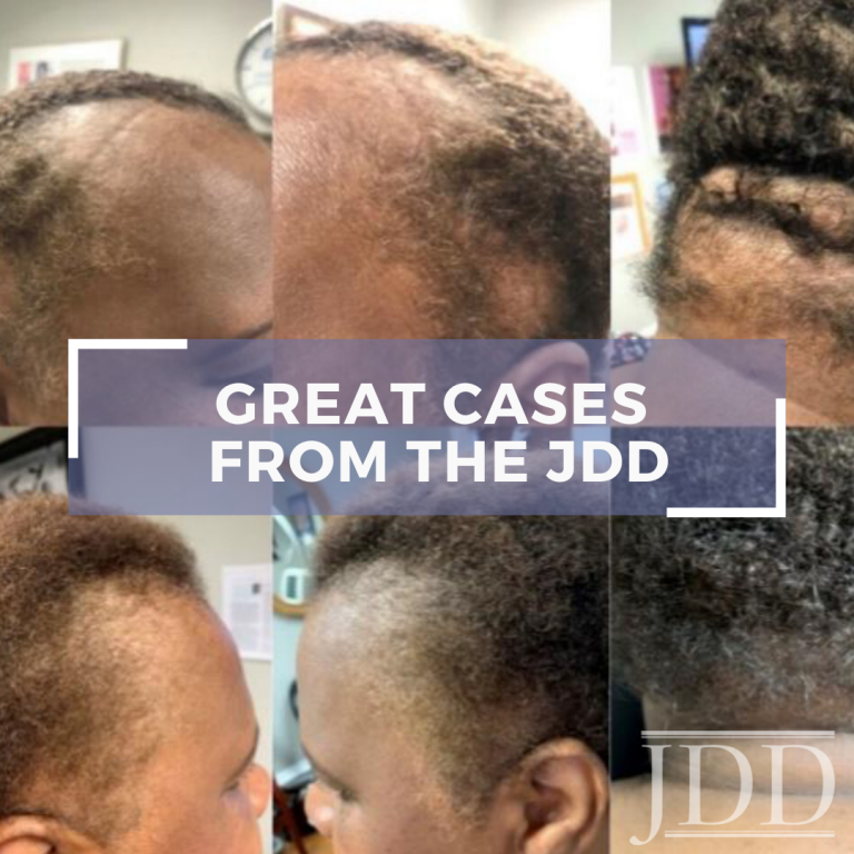 A Closer Look at a Multi-Targeted Approach to Hair Loss in African