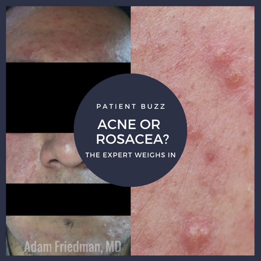 Patient Buzz Acne or Papulopustular Rosacea? The Expert Weighs In