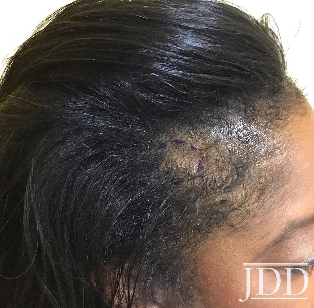 Frontal Fibrosing Alopecia Presenting as Androgenetic Alopecia in an  African American Woman - Next Steps in Dermatology