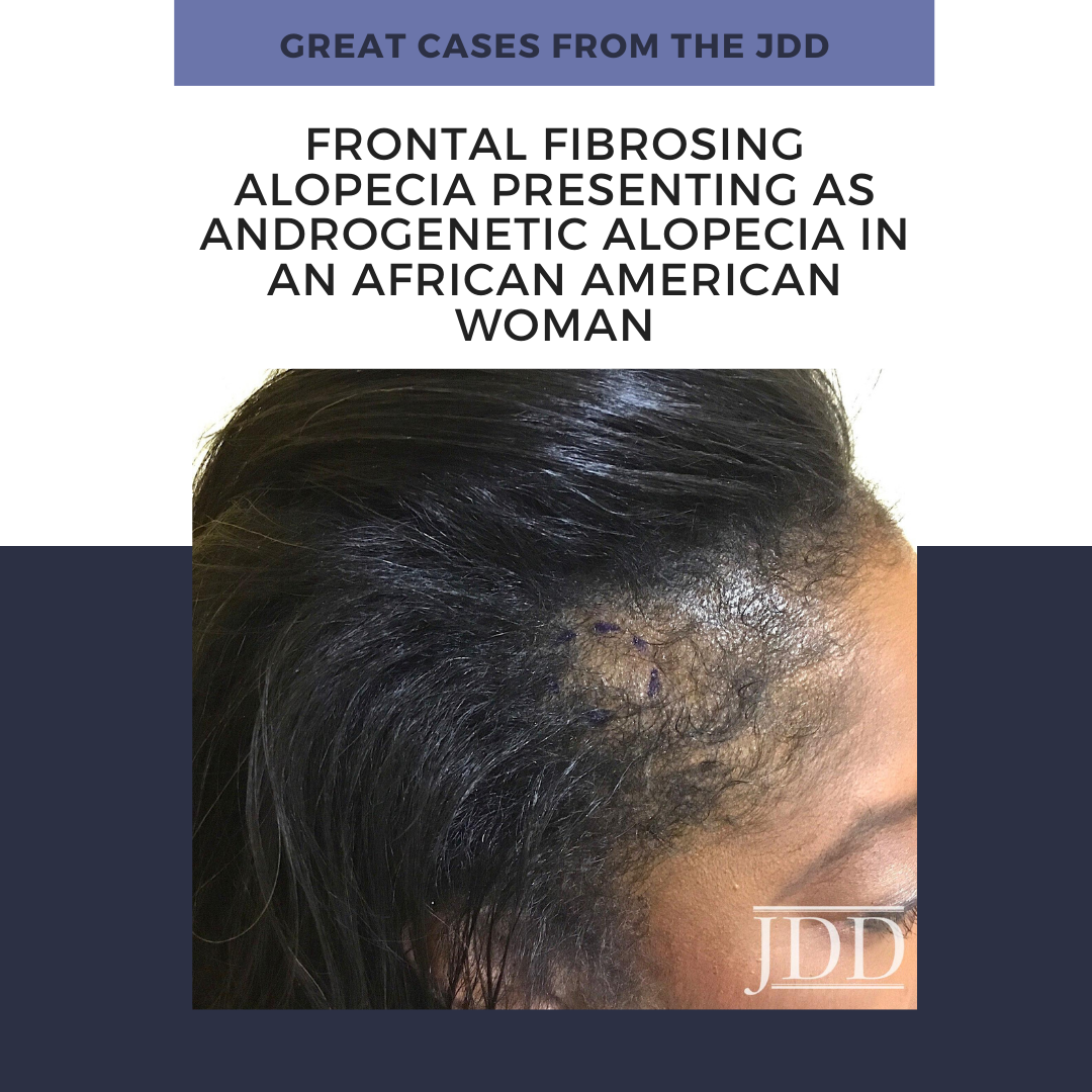 African American Woman with frontal fibrosis alopecia