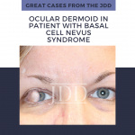 ocular dermoid
