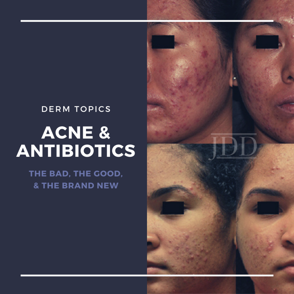 Antibiotics And Acne The Bad The Good And The Brand New Next Steps In Dermatology