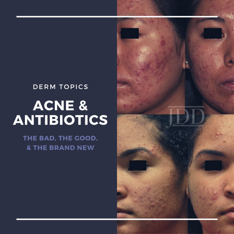 Antibiotics and Acne: the Bad, the Good, and the Brand New - Next Steps ...