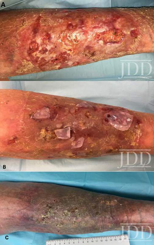 Erosive Pustular Dermatosis