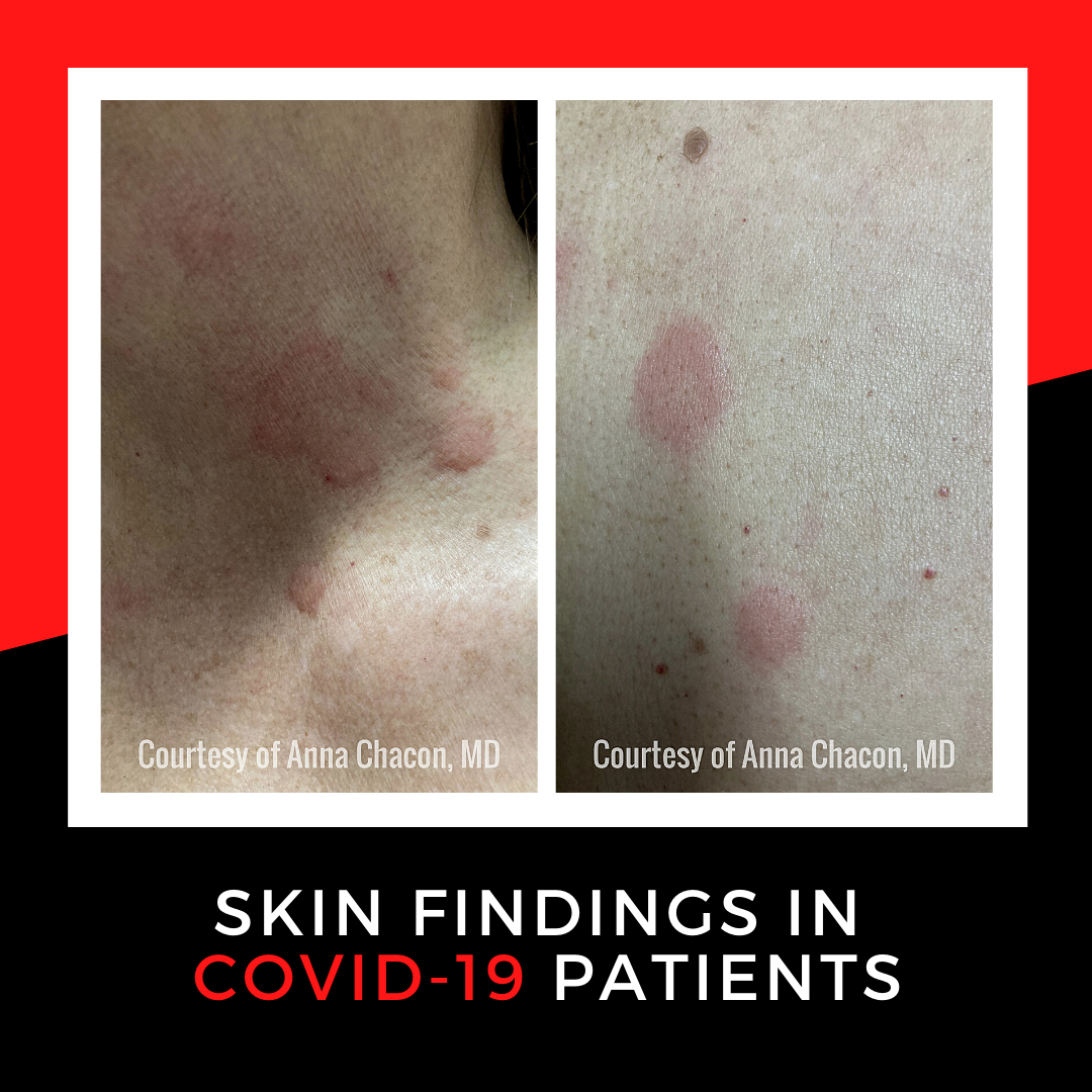 Skin Findings in COVID-19 Patients