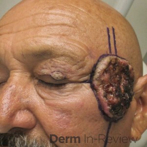 Temporal nerve injury