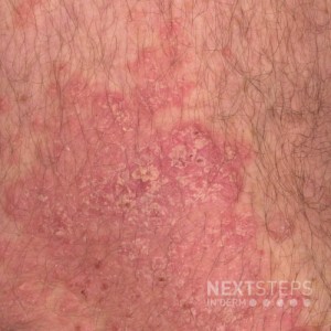 Psoriasis