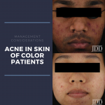 Acne in Skin of color patients