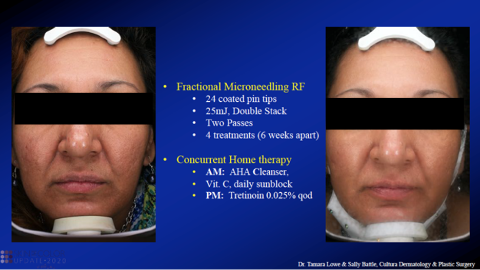 Fractional micro needling