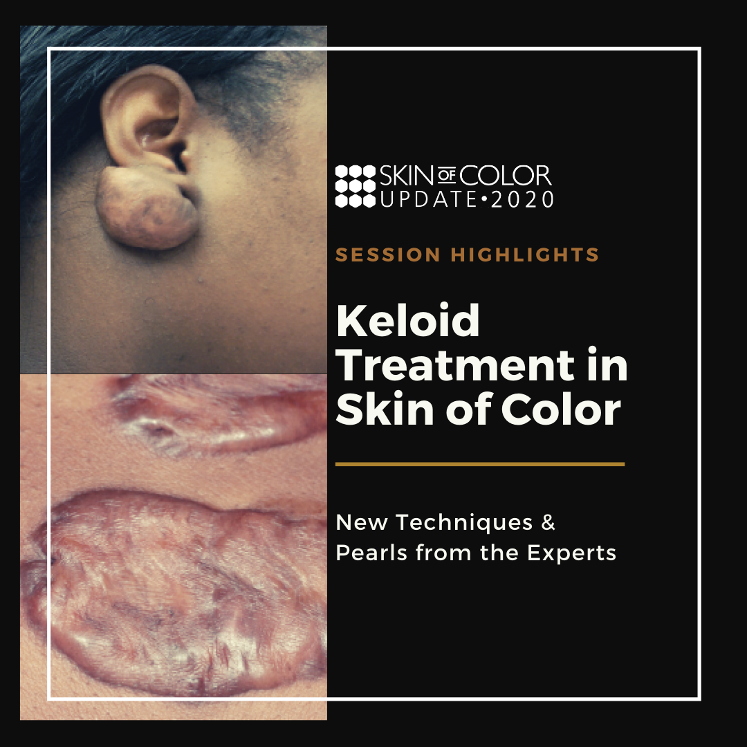 Keloid Treatment in Skin of Color New Techniques & Pearls from the