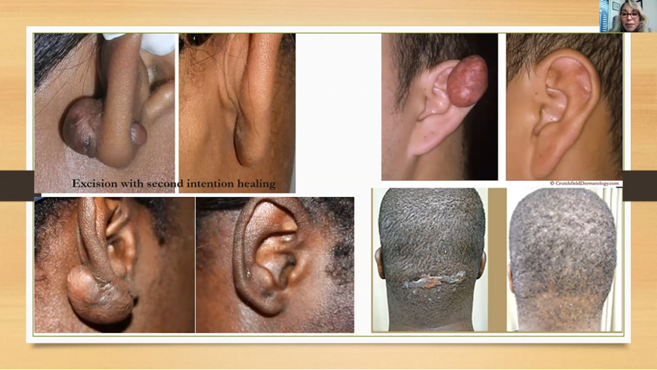 Keloids in SOC