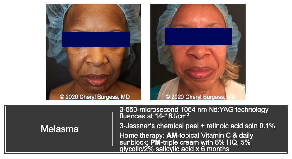 Melasma Treatment Before & After