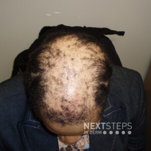 cicatricial alopecia