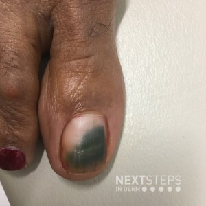Green Nail Syndrome – Friday Pop Quiz 12/4 - Next Steps in Dermatology
