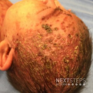 eborrheic dermatitis