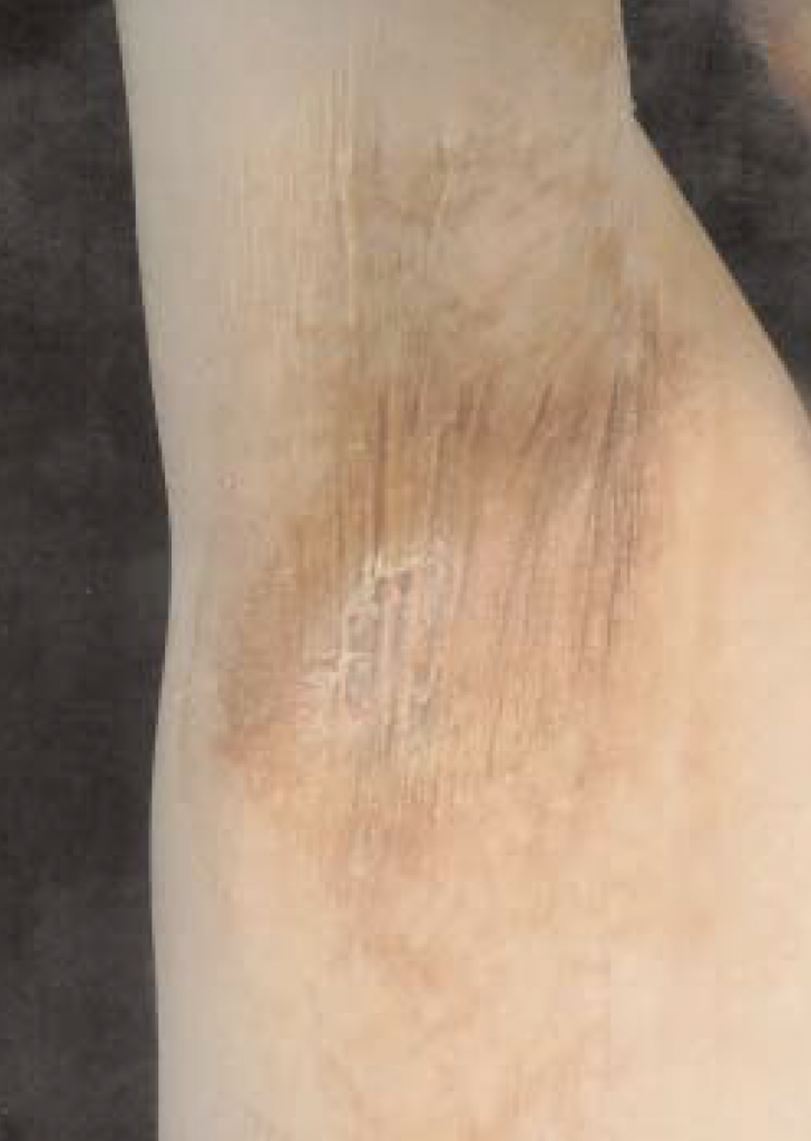 erythematous scaly rash affecting the axillae