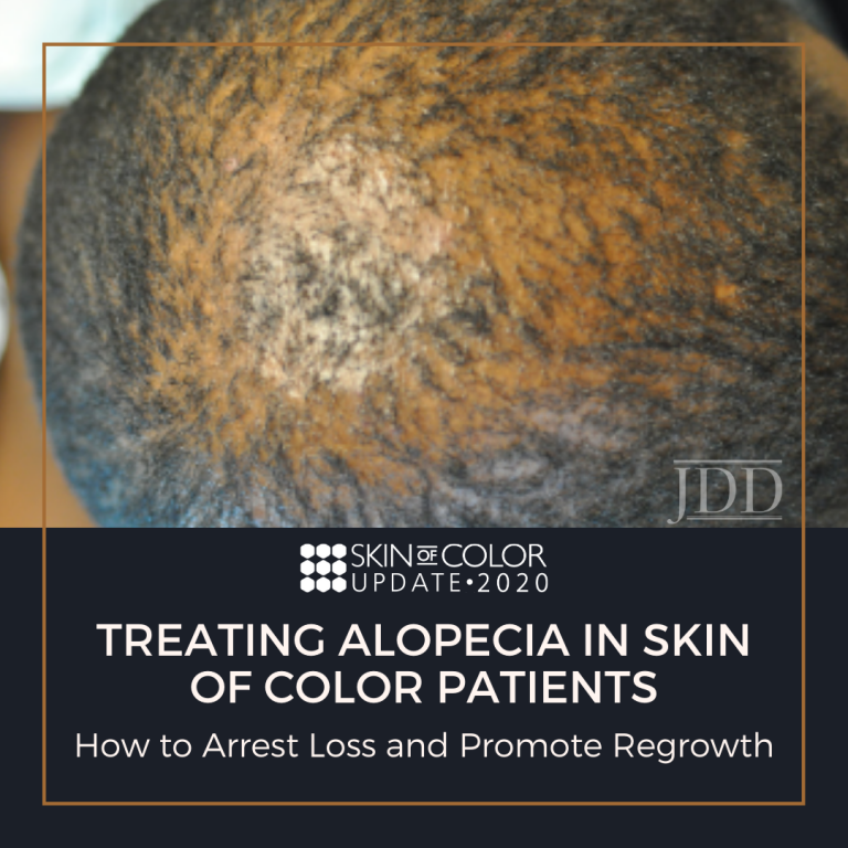 Treating Alopecia in Skin of Color Patients: How to Arrest Loss and ...