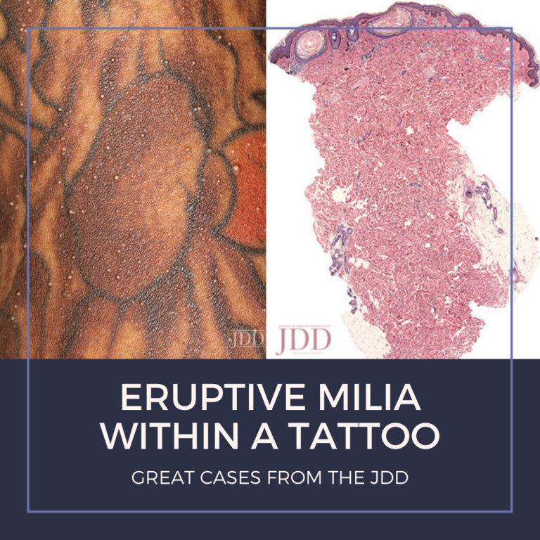 Eruptive Milia Within a Tattoo Next Steps in Dermatology