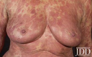 Mycosis fungoides