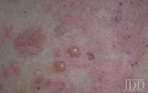 Bullous pemphigoid