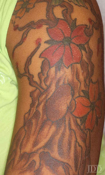 Why Do I Have A Rash On My New Tattoo  Symptoms Causes  Treatment   Tattify