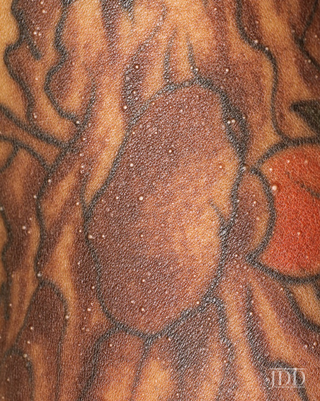 Eruptive Milia Within a Tattoo  Next Steps in Dermatology