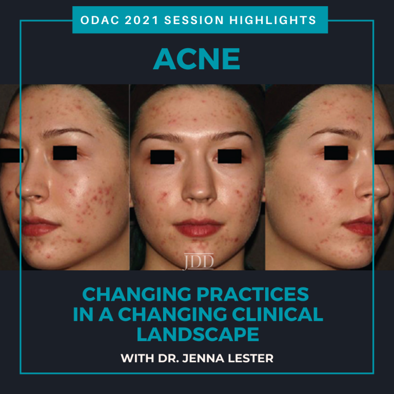 Acne: Changing Practices in a Changing Clinical Landscape - Next Steps in Dermatology