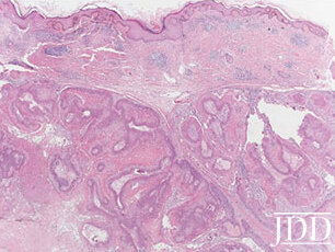 Multinodular dermal neoplasm with trichilemmal squamous differentiation