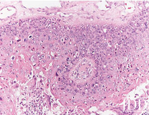 Neoplastic keratinocytes with pale cytoplasm, mild cytologic atypia, and necrotic cells (original magnification x200).